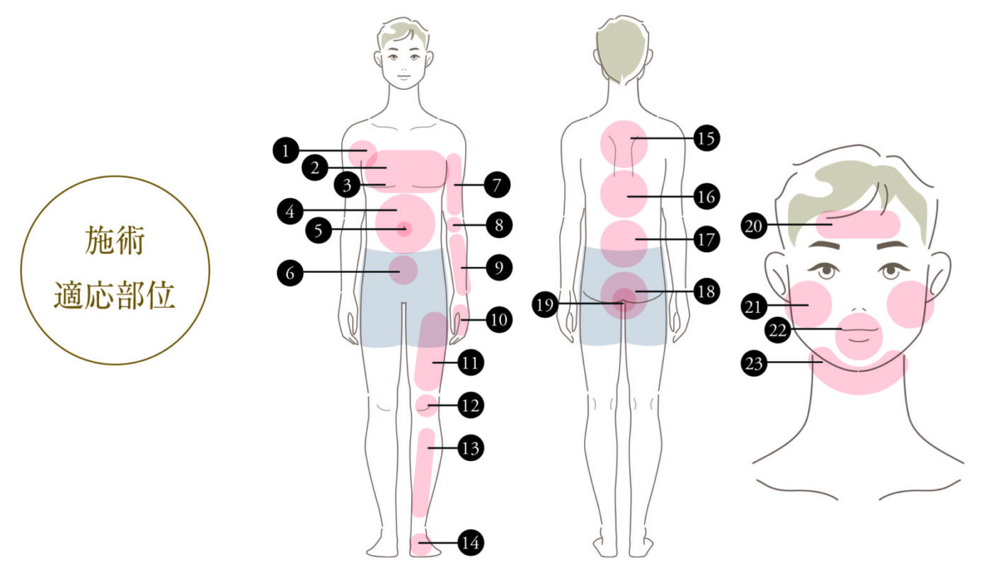 男性医療脱毛 施術適応部位