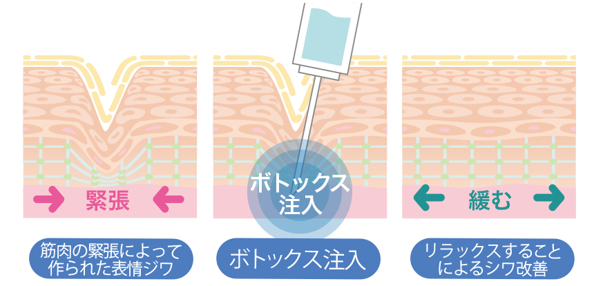 ボトックス注入概要