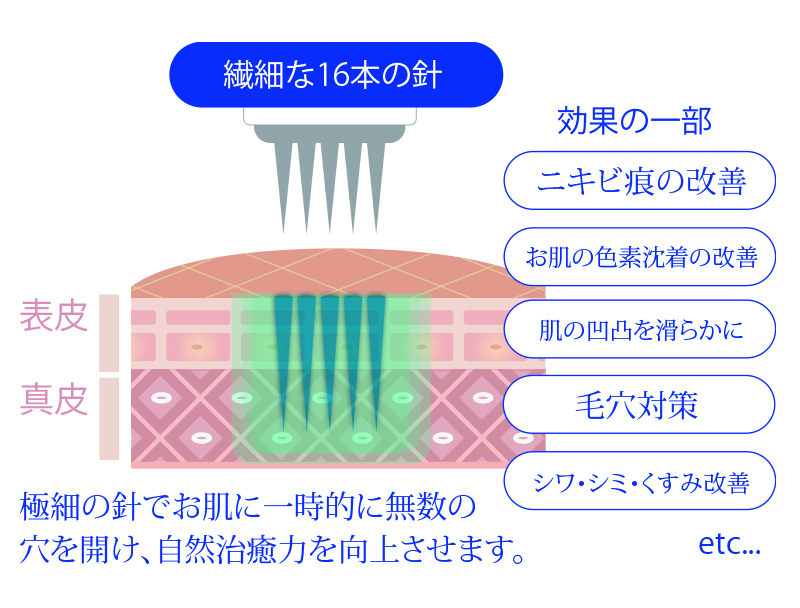 ダーマペン4_施術概要