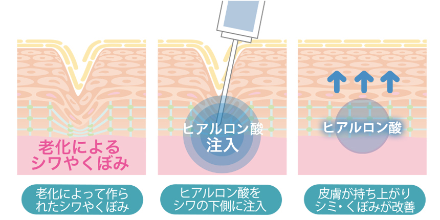 ヒアルロン酸注入の概要