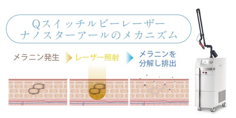 Qスイッチルビーレーザー ナノスターアールのメカニズム