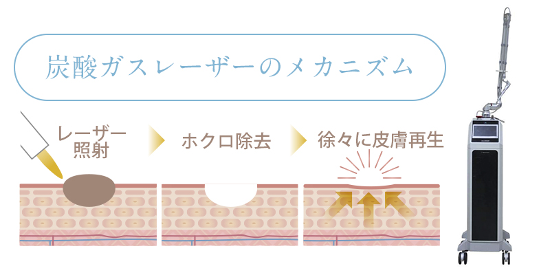 炭酸ガスレーザーのメカニズム