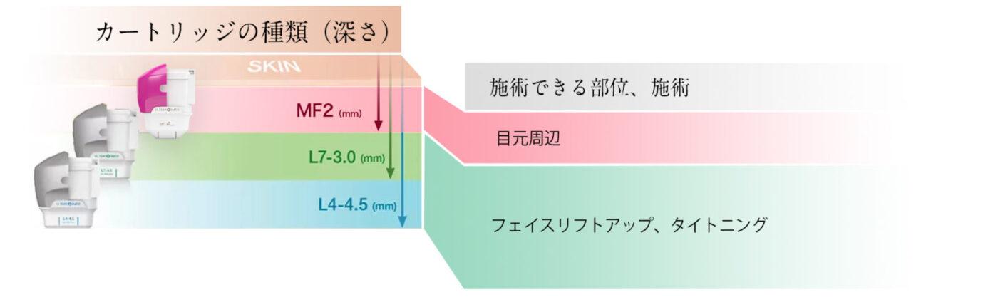 ウルトラフォーマ カートリッジ種類