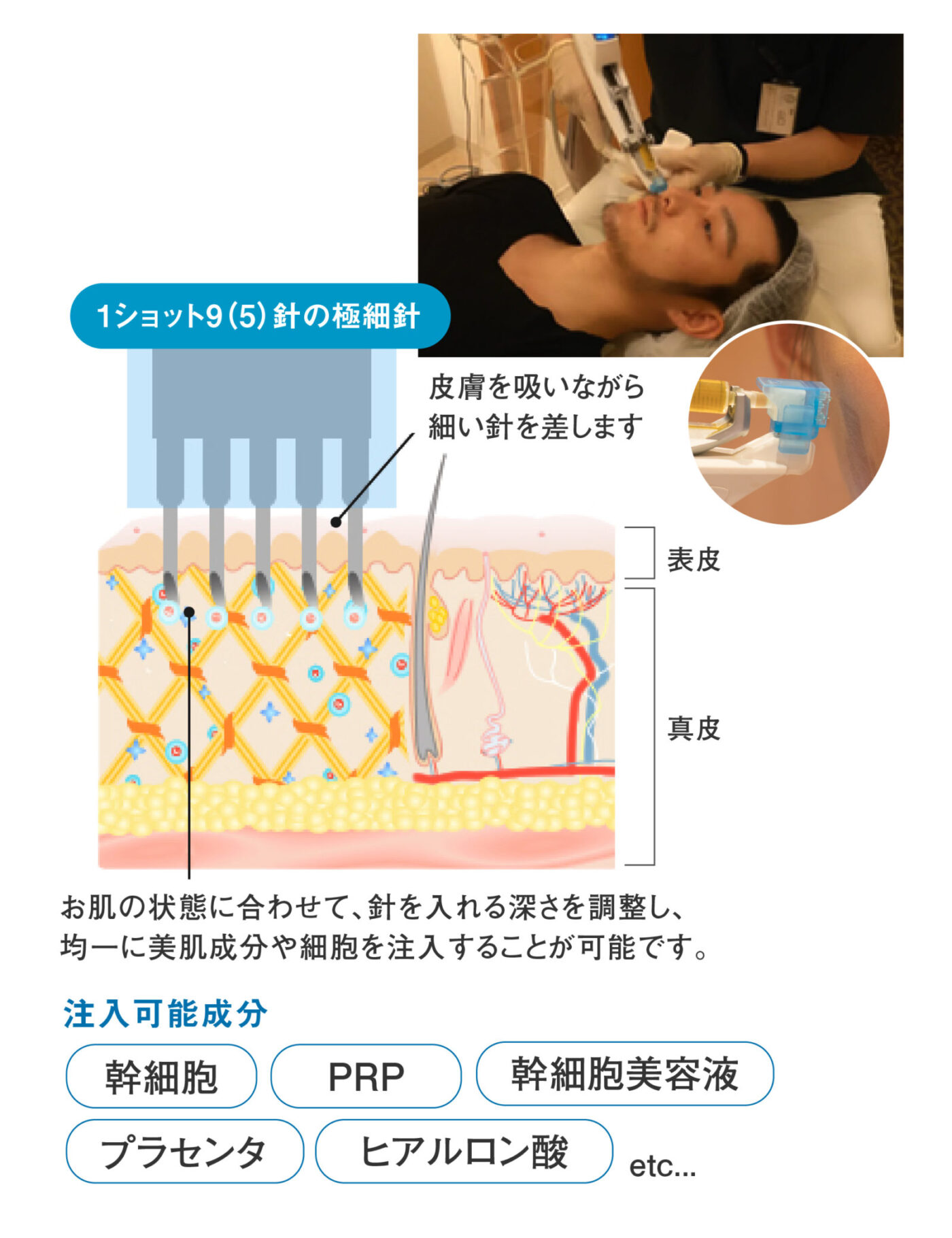 水光注射とは