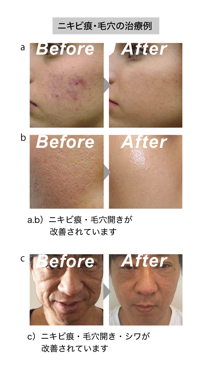 Treatment examples for acne scars and pores