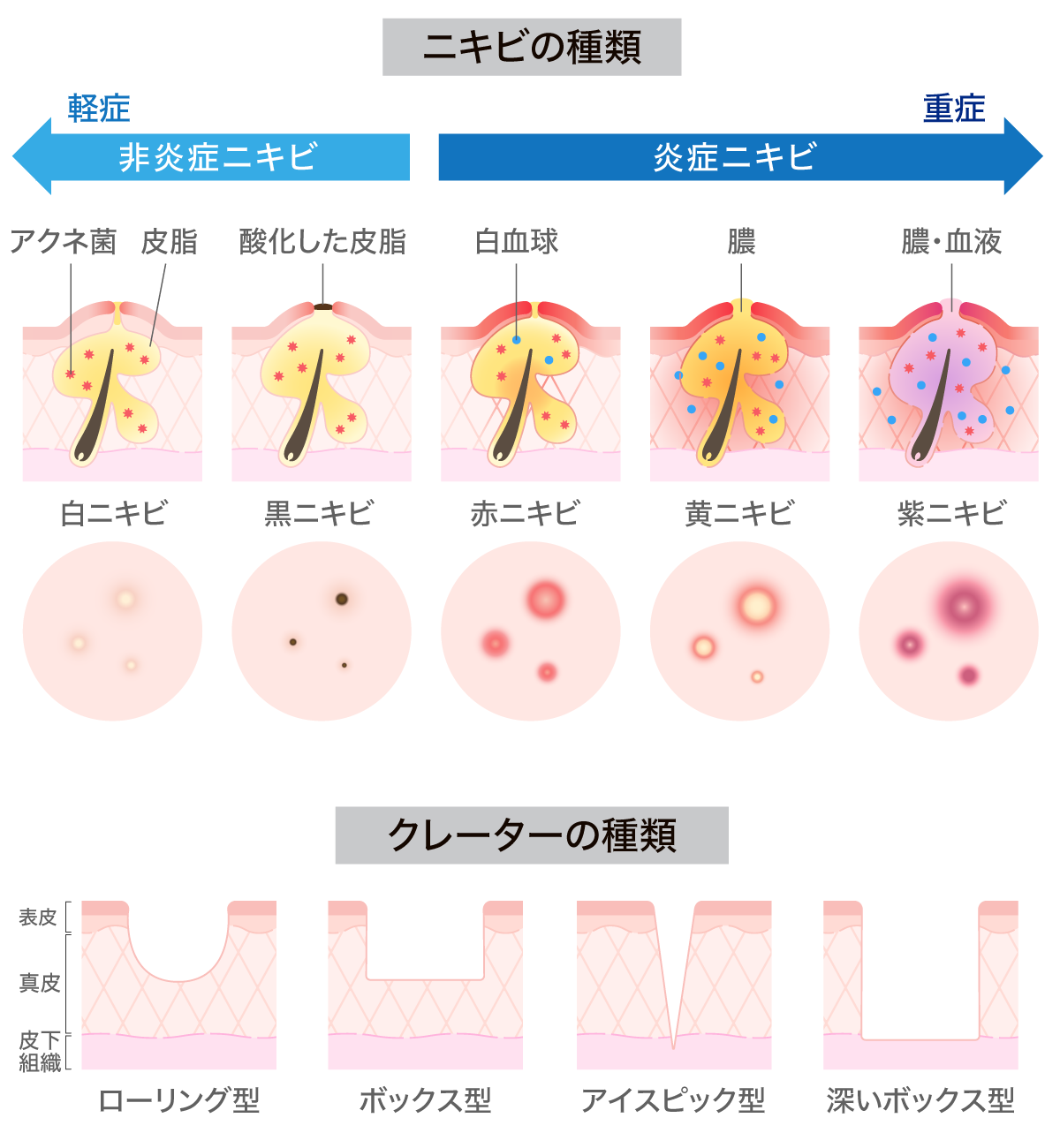 ニキビの種類とクレーター