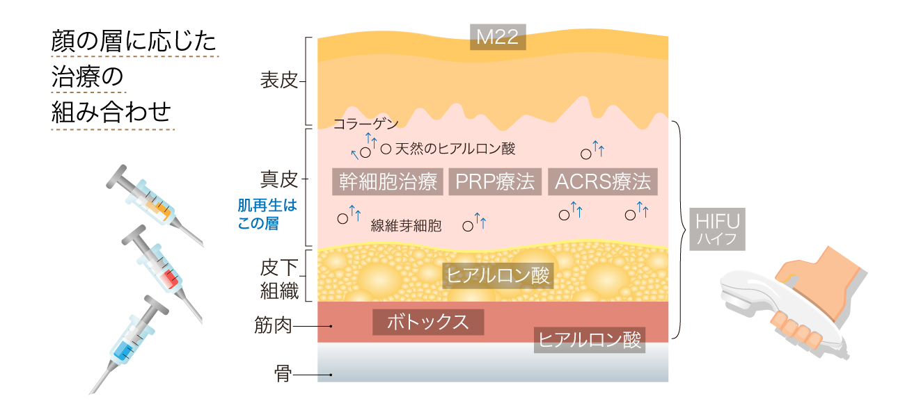 たるみ治療、たるみ改善、たるみ、フェイスアップ