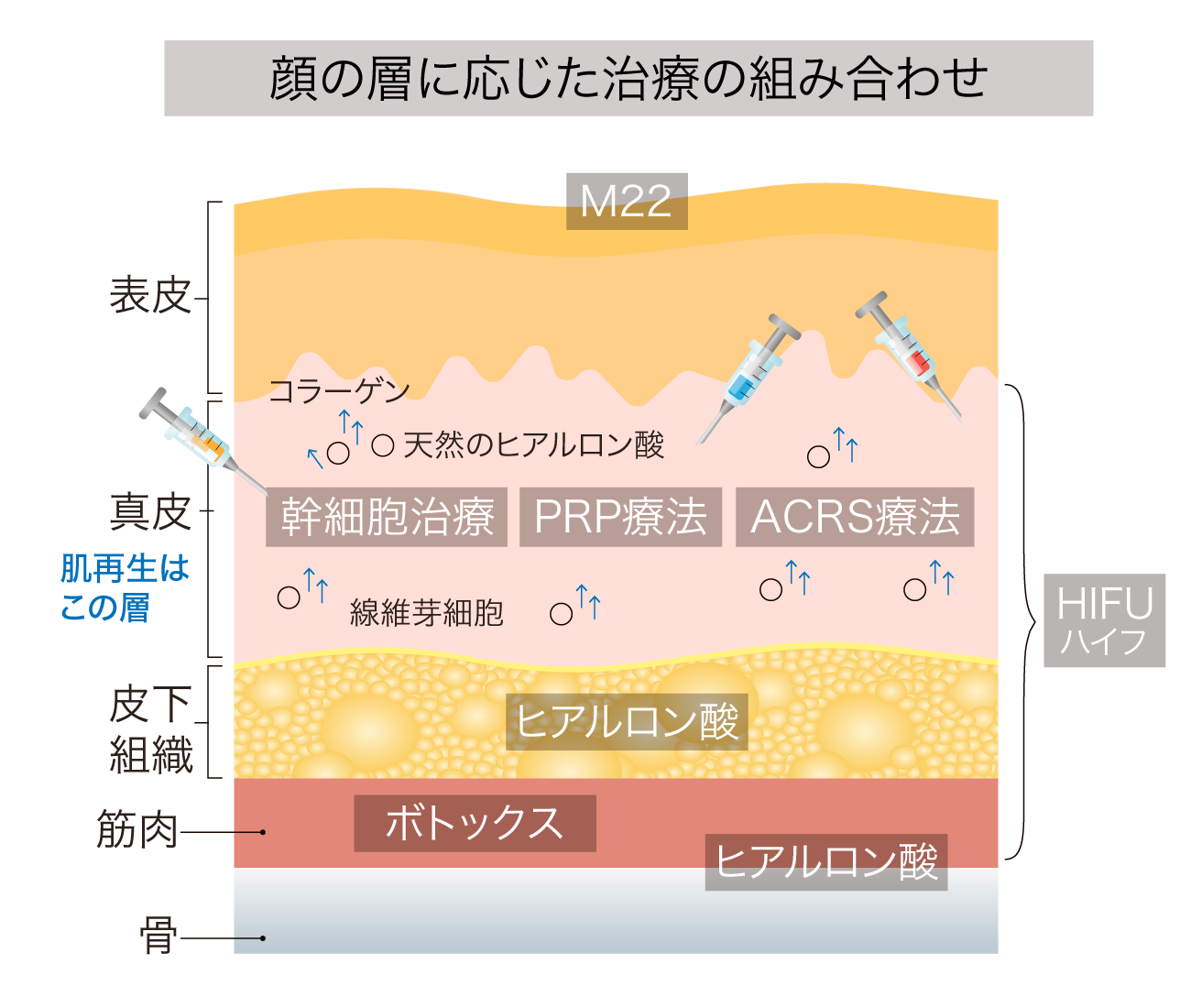 たるみ治療、たるみ改善、たるみ、フェイスアップ