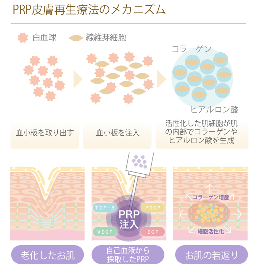 非架橋ヒアルロン酸