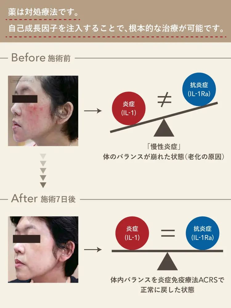 ACRS療法の効果