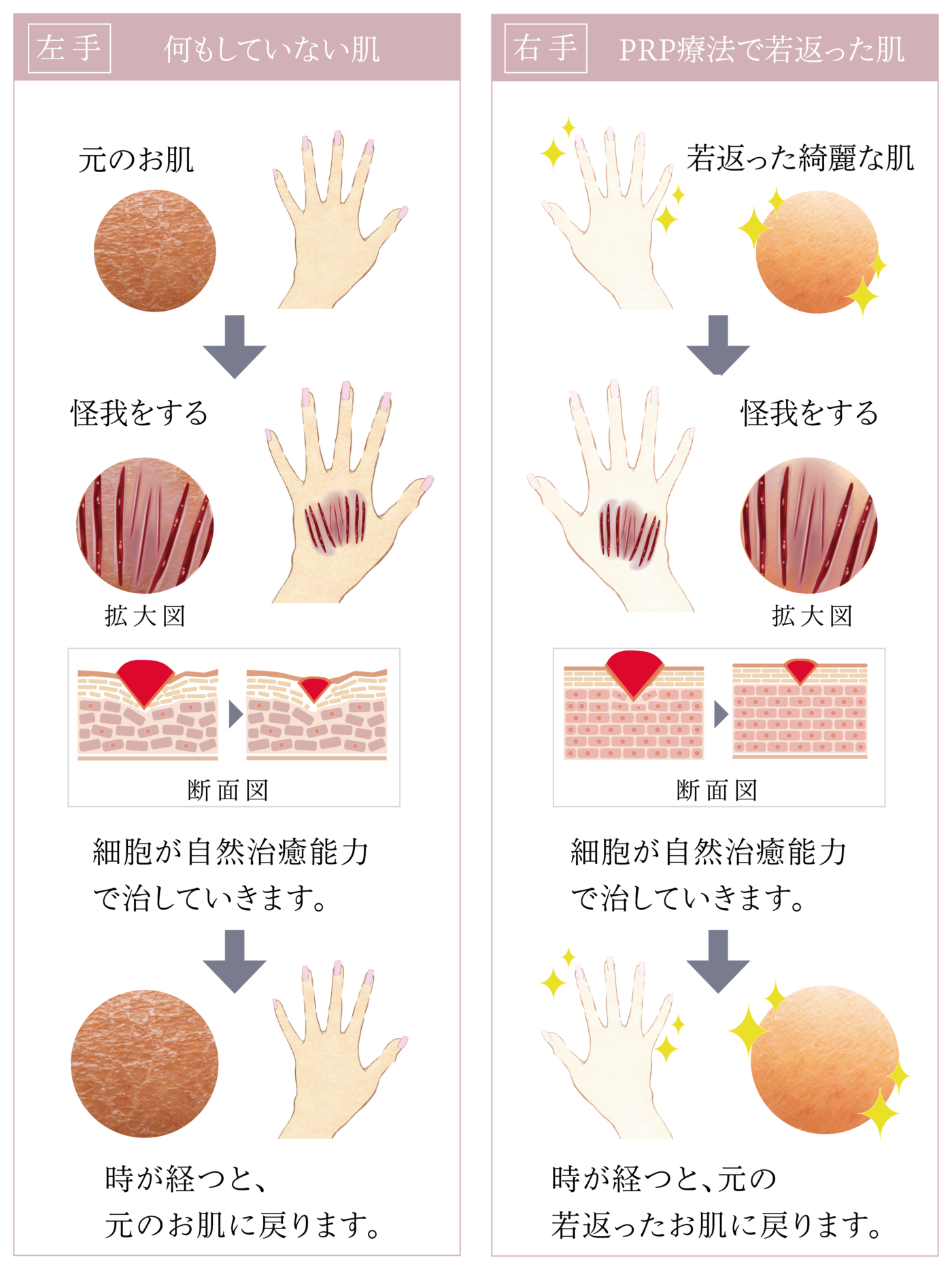 sp幹細胞＿手の図-prp