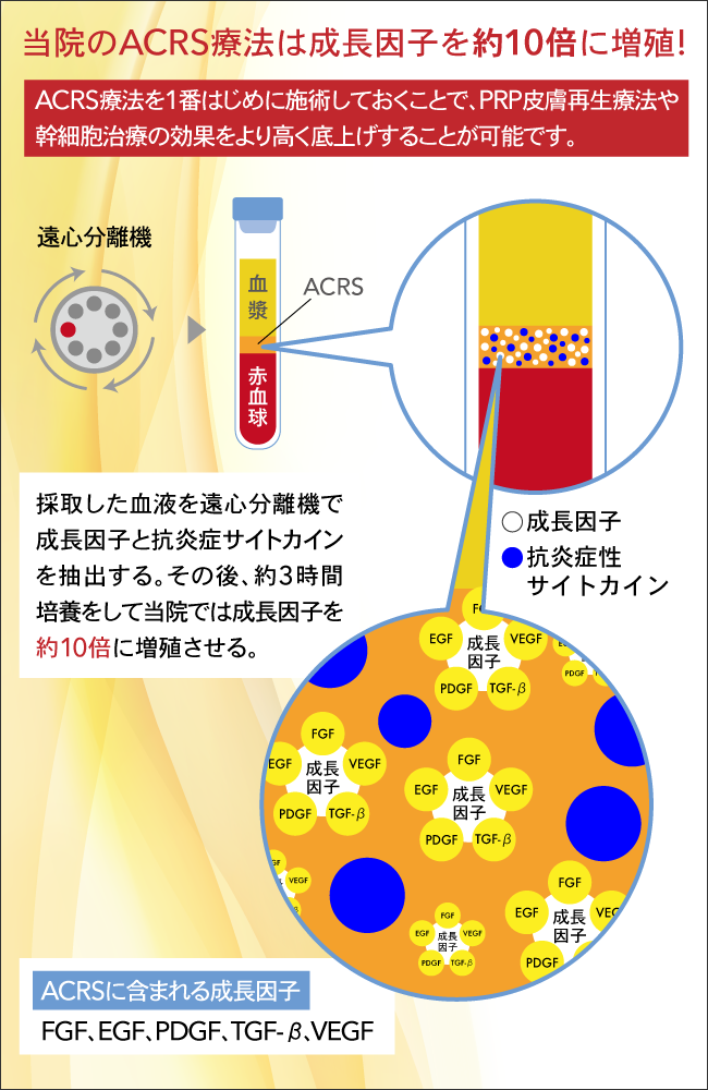 成長因子　10倍　ACRS