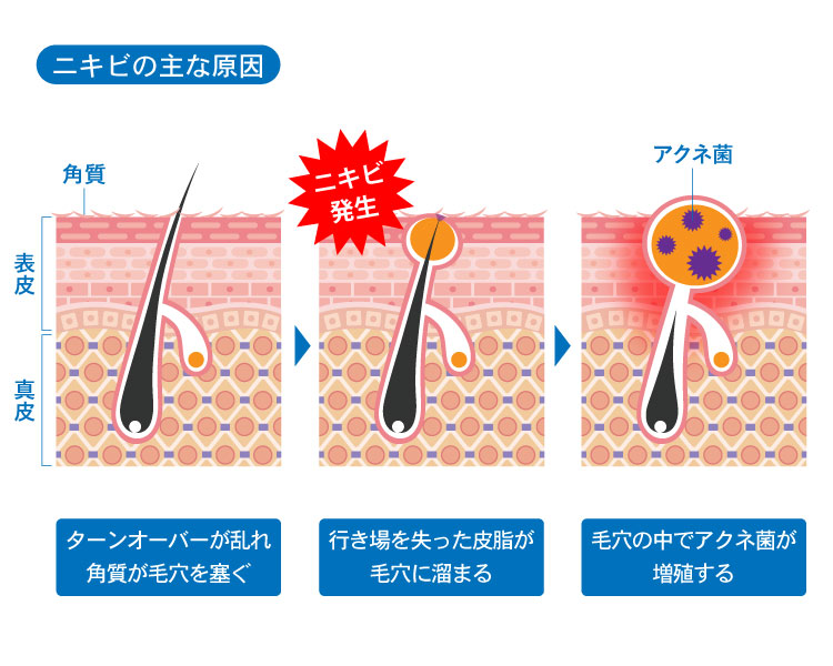 ニキビ　原因　アクネ菌　角質